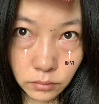 眼袋
