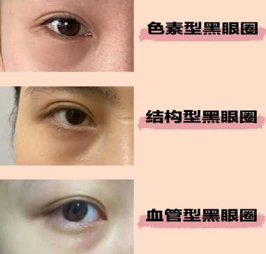 眼袋