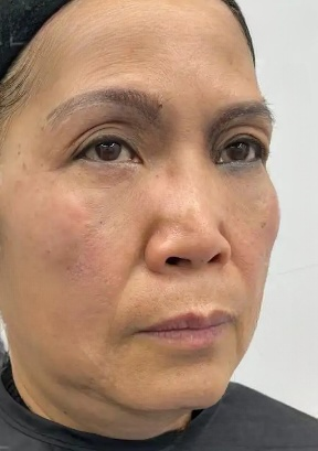 去眼袋手术