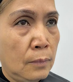 去眼袋手术