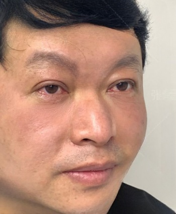 去眼袋手术
