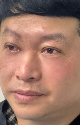 去眼袋手术