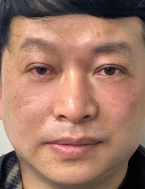 去眼袋手术