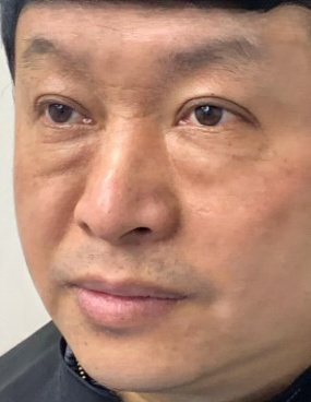 去眼袋手术