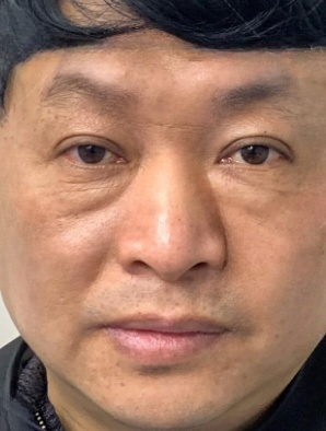去眼袋手术