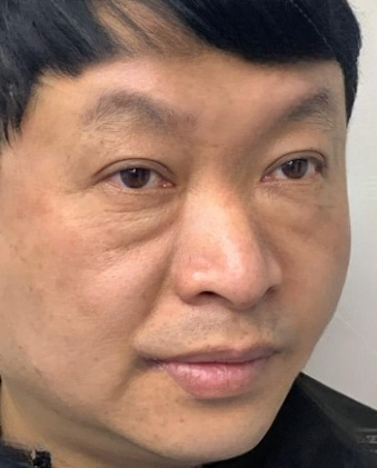 去眼袋手术