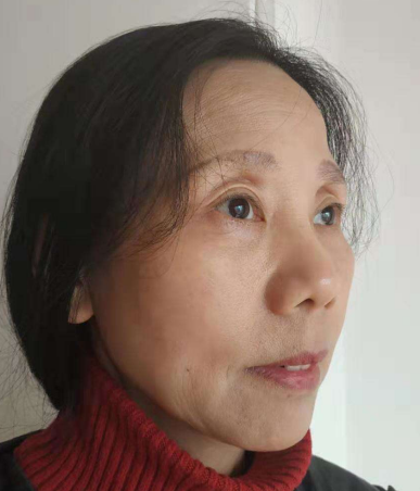 去眼袋手术