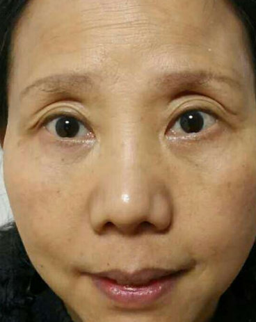 去眼袋手术