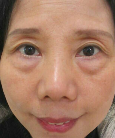 去眼袋手术