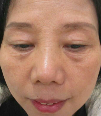 去眼袋手术
