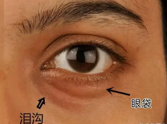 去眼袋手术