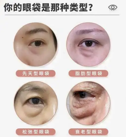 去眼袋手术