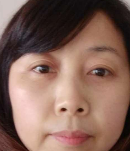 去眼袋手术