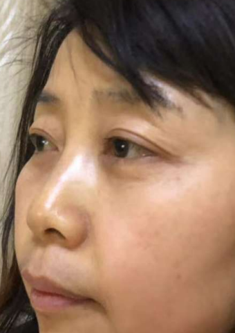 去眼袋手术