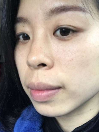 去眼袋手术