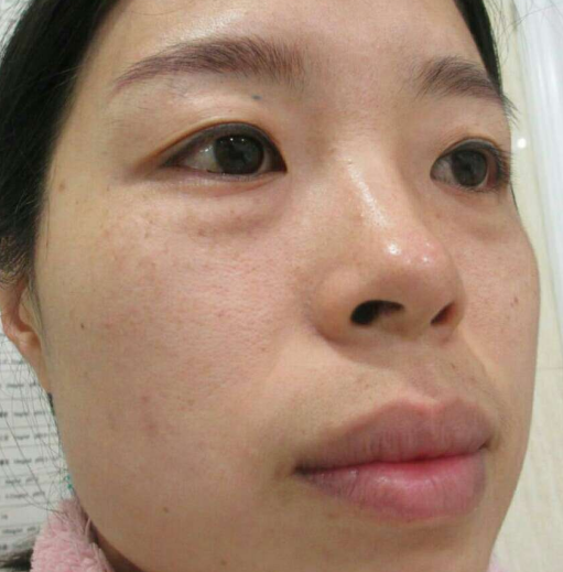 去眼袋手术
