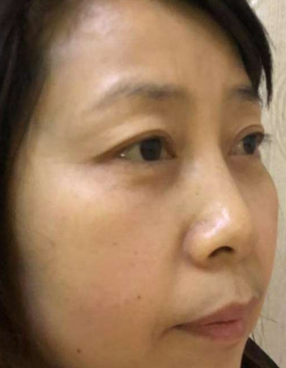 去眼袋手术