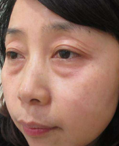去眼袋手术