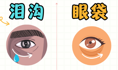 去眼袋手术