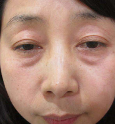 去眼袋手术