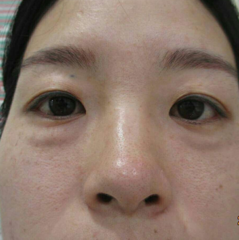 去眼袋手术