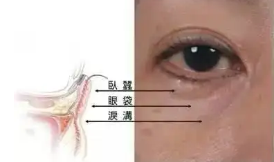 去眼袋手术