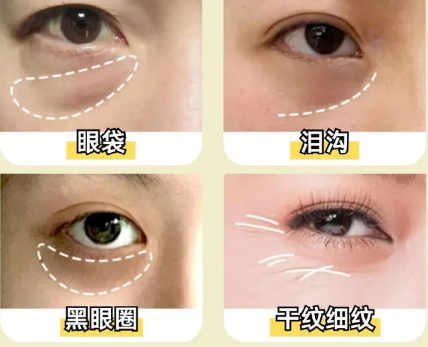 去眼袋手术