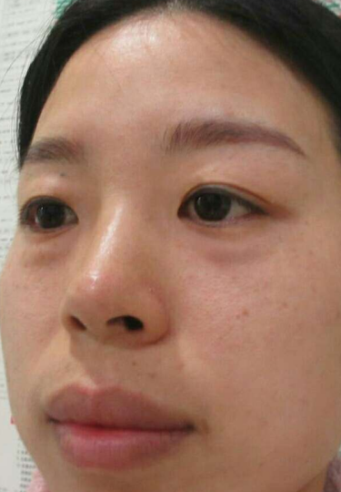 去眼袋手术