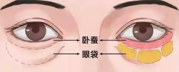 眼袋