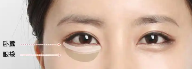 眼袋