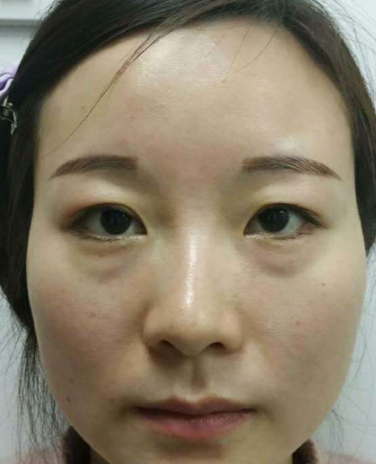 眼袋