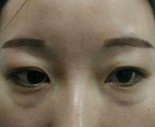 眼袋
