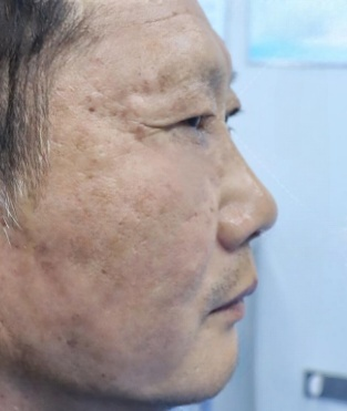 去眼袋手术