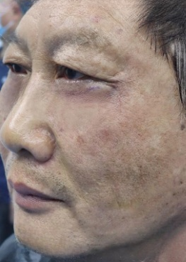 去眼袋手术