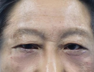去眼袋手术
