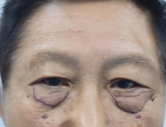 去眼袋手术