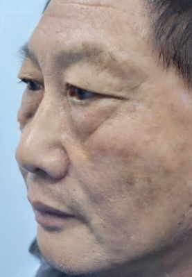 去眼袋手术