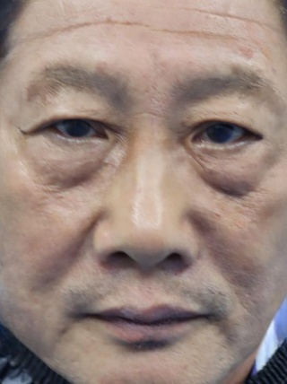 去眼袋手术
