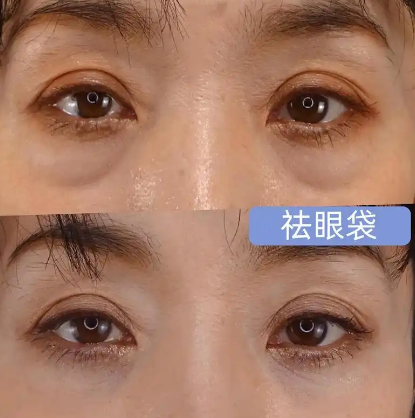 眼袋