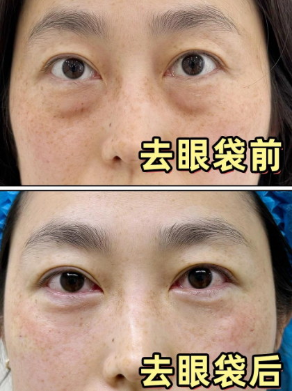 眼袋