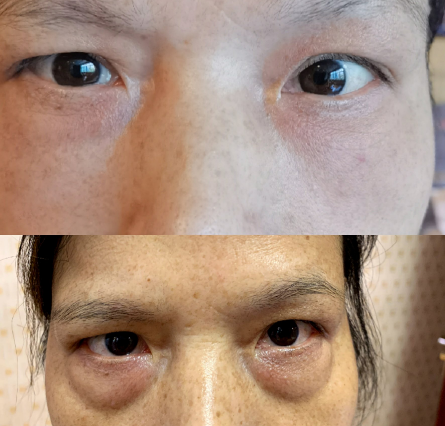 眼袋