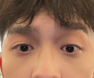 眼袋
