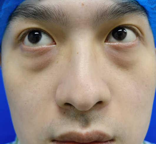眼袋