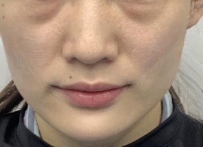 去眼袋手术
