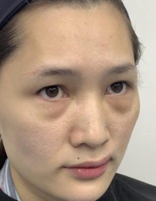 去眼袋手术