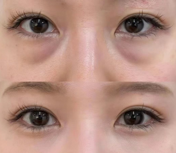 眼袋