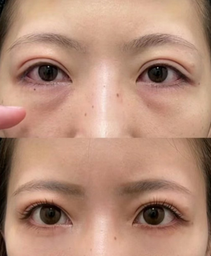 眼袋