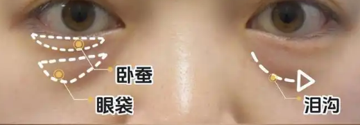 去眼袋手术