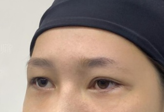 去眼袋手术