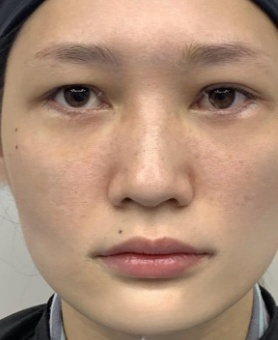 去眼袋手术